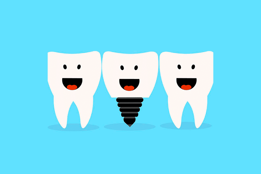 implantes dentales de alta gama