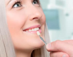 carillas dentales qué son y para que sirven