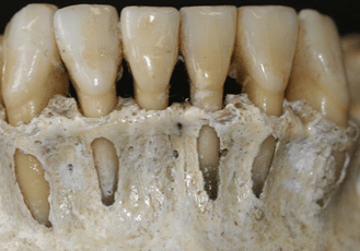 imagen de raiz de los dientes muy gruesa