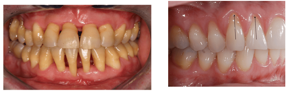 Paciente enfermedad periodontal Se ve la encía en otra posición, pero también se observa que el espacio entre los dientes está abierto