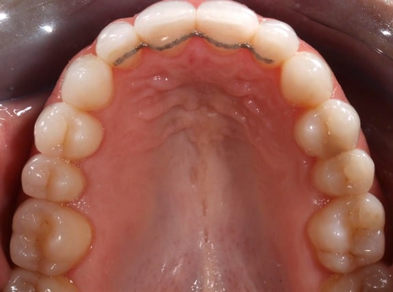 retenedor dental fijo tras ortodoncia. Retenedor dental de alambre.