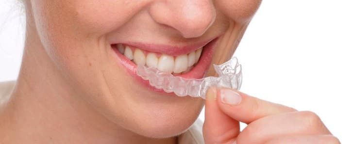 mujer con retenedor dental vivera transparente. Después de ortodoncia invisible.