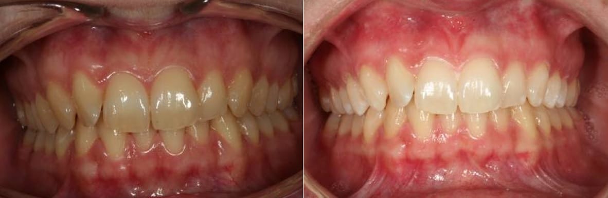 foto antes y despues blanqueamiento dental profesional clinica echeverria barcelona paciente 1