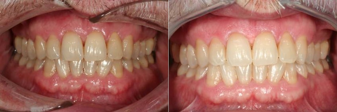 foto antes y despues blanqueamiento dental profesional clinica echeverria barcelona paciente 2