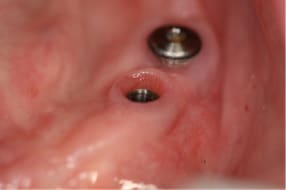 implante en molar, encía un mes después de haber colocado el implante con y sin el tapón de cicatrización