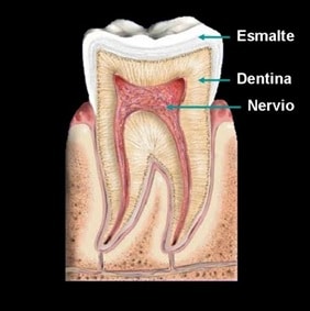 estructura de un diente cuando se forma una caries dental