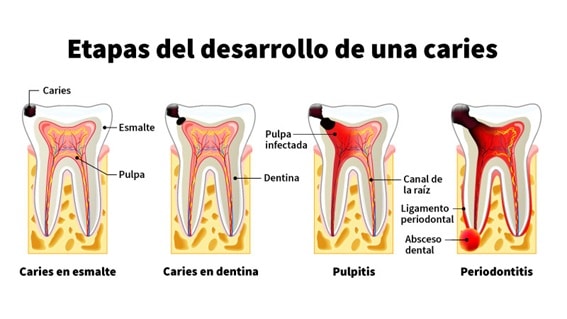 etapas de desarrollo de una caries dental 