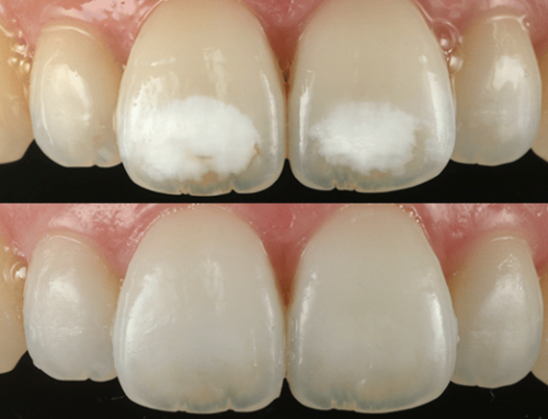 Hipoplasia del esmalte: manchas blancas o marrones en dientes de adulto