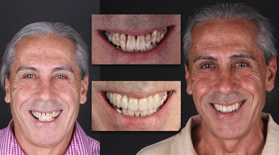 Ejemplo tratamiento infeccion implantes dentales