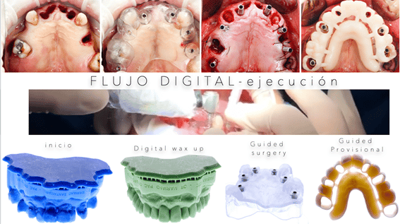 flujo digital ejecución tratamiento infeccion implantes dentales
