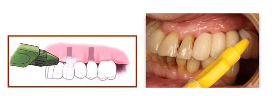 Imagen sobre cómo deben limpiarse los implantes para que no se infecten