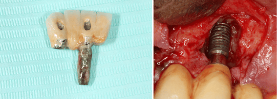 Infección implantes con dos imágenes del aspecto que tienen los implantes enfermos por periimplantitis.