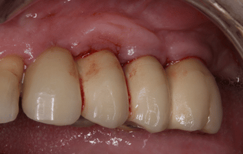 infeccion implantes dentales encía inflamada y sangrando