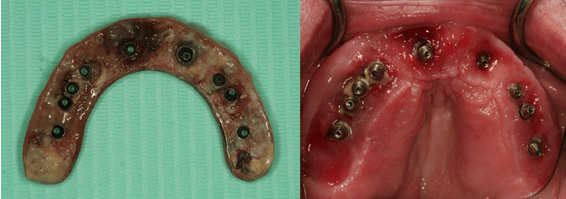 protesis muy sucia que provoca infección en el implante dental