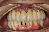 complicacion implante dental