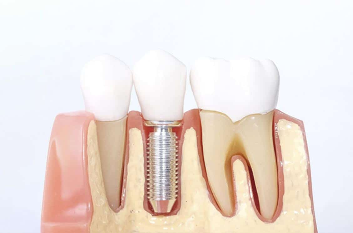 implantes dentales barcelona