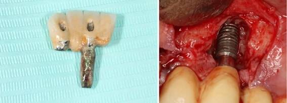 implantes enfermos por perimplantitis