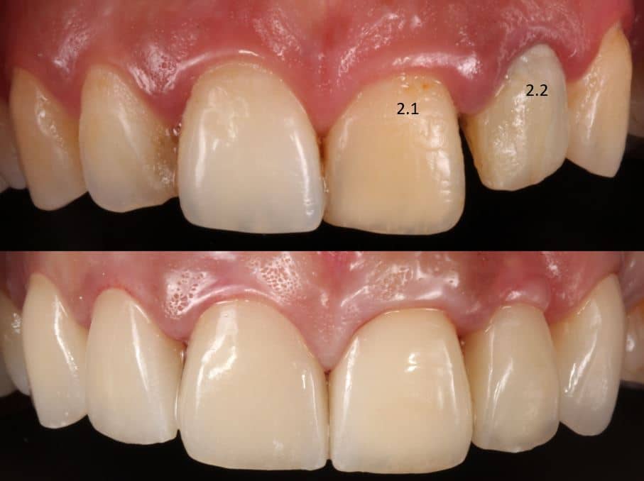 caso sencillo carillas dentales con dientes separados