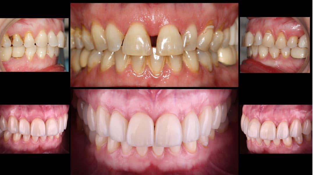 carillas antes y despues caso dientes muy separados
