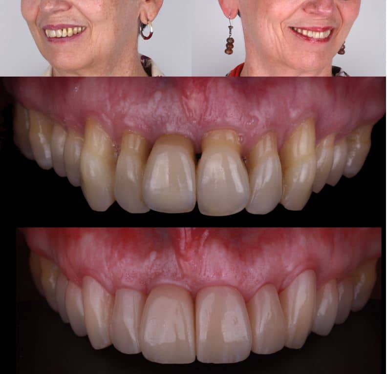 carillas antes y despues con paciente en tratamiento de periodoncia