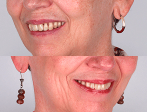 Carillas dentales antes y después: 4 casos reales con foto