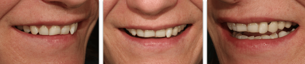 evolución de los dientes cuando se desgastan en una mujer