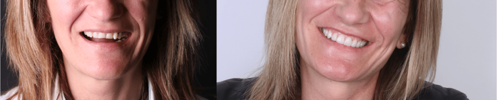 antes y despues mujer desgaste dental y tratamiento