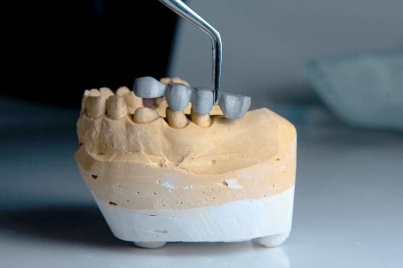 tipos-protesis-dental