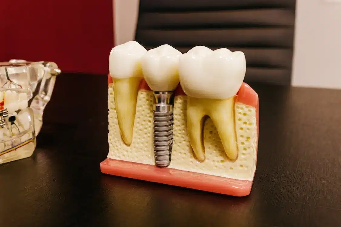 como son los implantes dentales